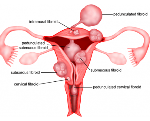 تصویر-میوم-رحمی-چیست-8965