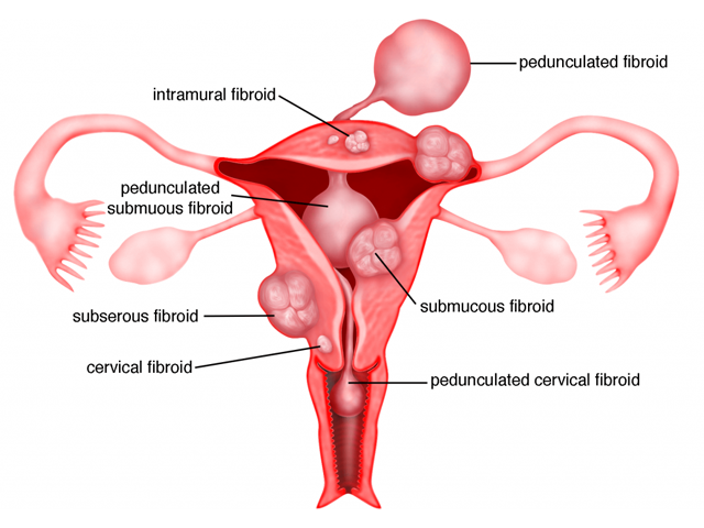 تصویر-میوم-رحمی-چیست-8965