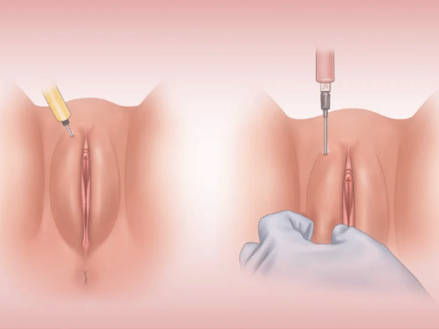 تصویر-ورم-بعد-از-تزریق-چربی-به-واژن-8473