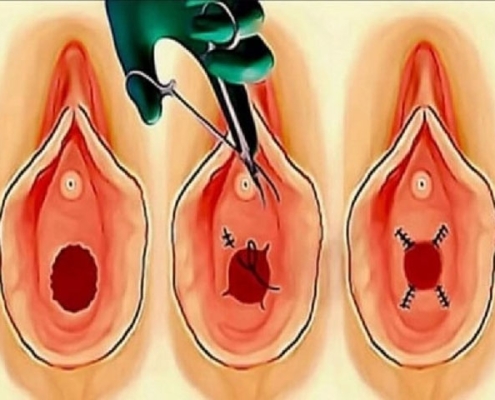 تصویر-ترمیم-پرده-بکارت-9890