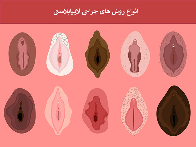 انواع روش های جراحی لابیاپلاستی