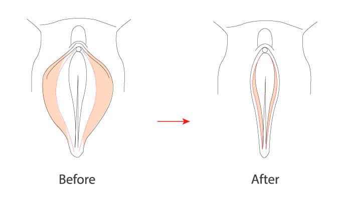 بهترین زمان برای عمل زیبایی واژن