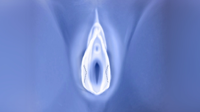 انواع عمل لابیاپلاستی