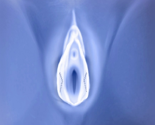 انواع عمل لابیاپلاستی