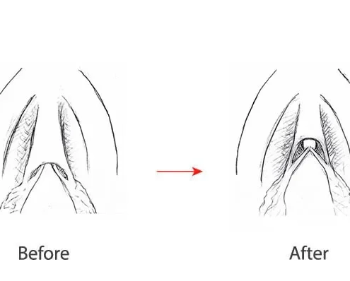 جراحی هودکتومی