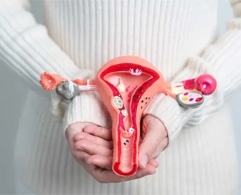 پولیپ های رحم