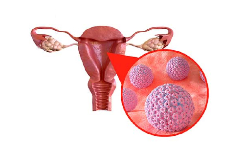 سریع ترین روش درمان زگیل تناسلی