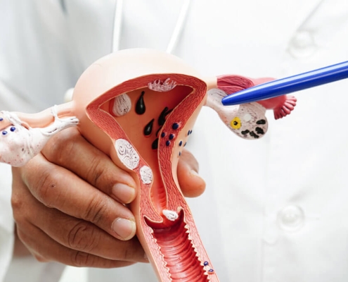 درمان زخم دهانه رحم