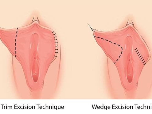 کاربرد عمل لابیاپلاستی