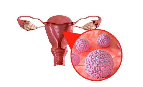 علت زگیل تناسلی بدون رابطه