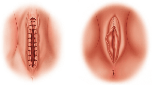 لابیاپلاستی بدون بخیه و بیهوشی