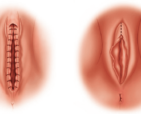 لابیاپلاستی بدون بخیه و بیهوشی