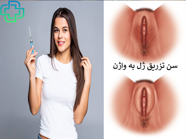 سن تزریق ژل به واژن و کاندید مناسب