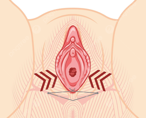 لیفت ناحیه تناسلی با نخ