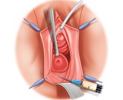 لیفت واژن و روش های آن