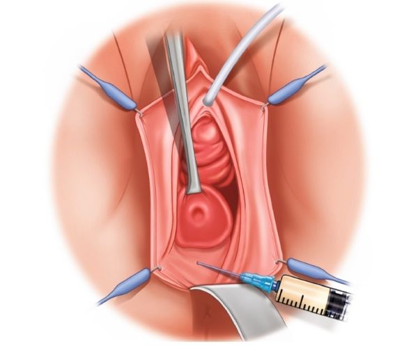 لیفت واژن و روش های آن