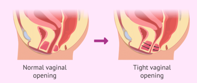 درمان واژینیسموس در میرداماد