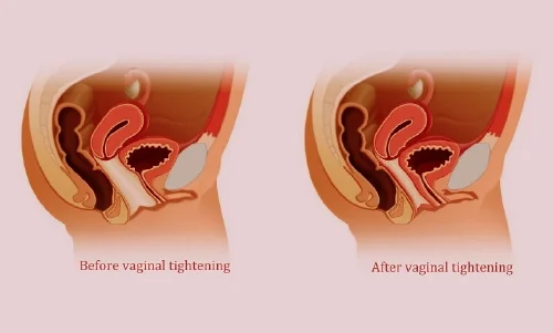 دکتر جوانسازی واژن در میرداماد