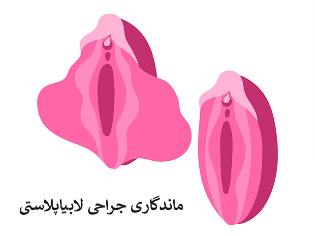 ماندگاری جراحی لابیاپلاستی
