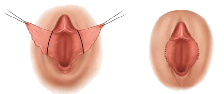اطلاعات ضروری پیش از جراحی لابیاپلاستی 