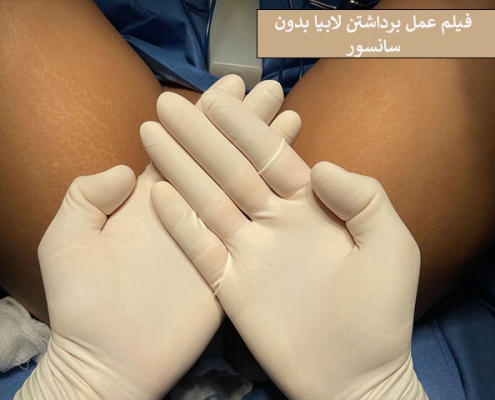 فیلم عمل برداشتن لابیا بدون سانسور