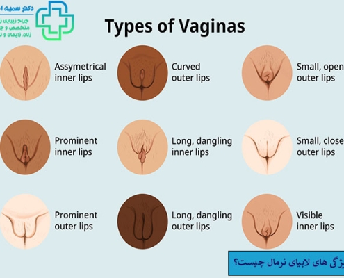 ویژگی های لابیای نرمال چیست؟