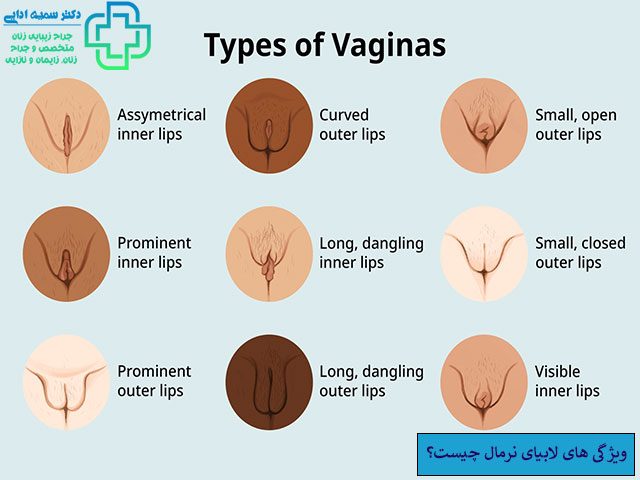 ویژگی های لابیای نرمال چیست؟