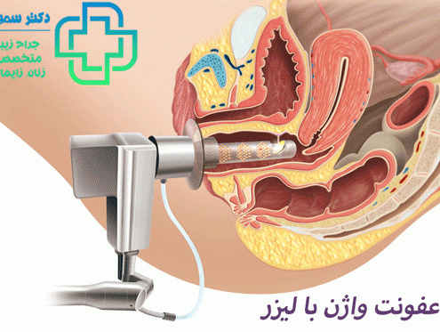درمان عفونت واژن با لیزر