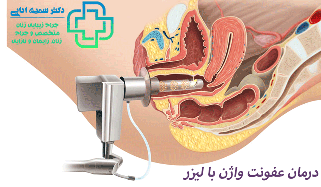 درمان عفونت واژن با لیزر