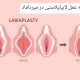 هزینه عمل لابیاپلاستی در میرداماد